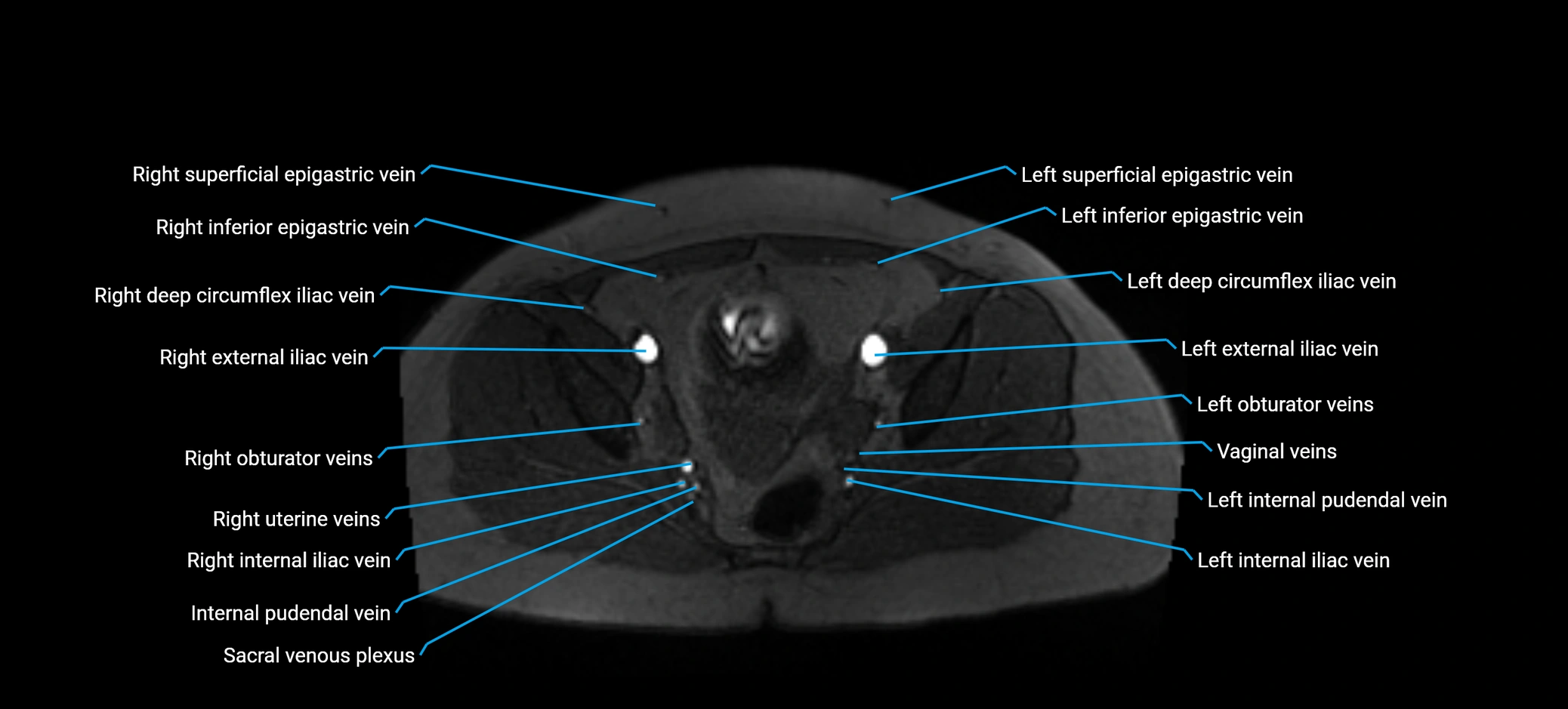 MRV abdomen pelvis & lower limb axial cross sectional anatomy labelled MRI image 162 (1).webp